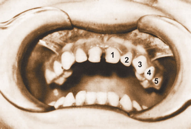 تقسيم الاسنان البنية